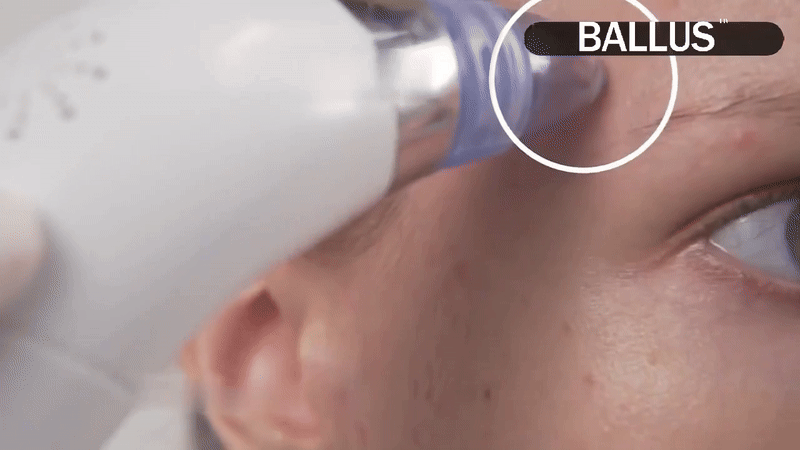 Derma Suction Pore Cleaning Device
